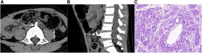 Frontiers Case Report The Ct Features Of Pediatric Retroperitoneal